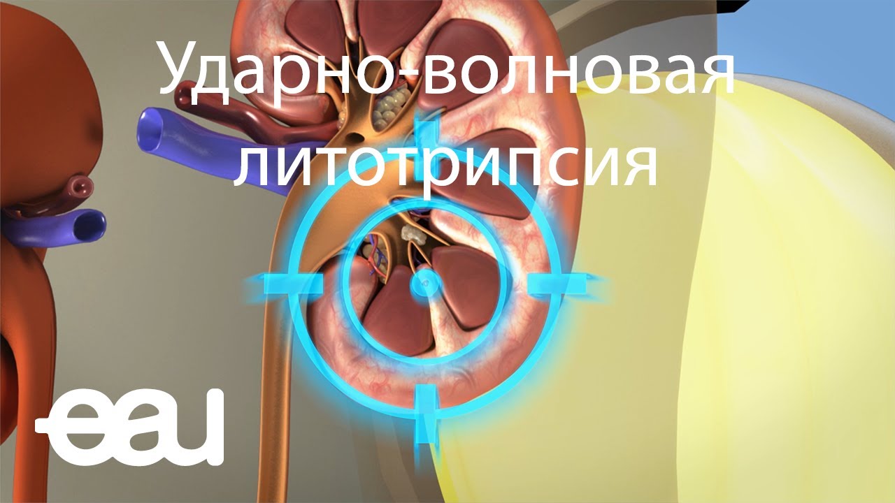 виды камней в почках виды камней в почках